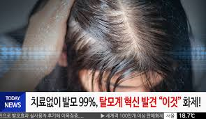 탈모정의증상 환경적유전적원인 탈모종류: 남성형DHT호르몬 치료시기단계 탈모정의증상 환경적유전적원인 탈모종류: 남성형DHT호르몬 치료시기단계