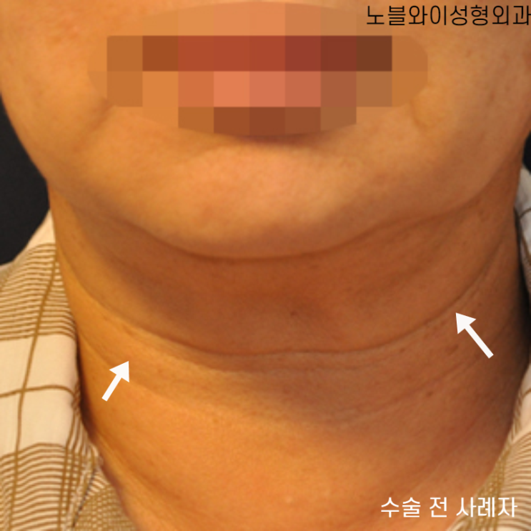  목주름수술비용 과연 합리적일까?