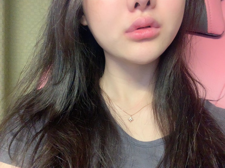  브잉라인 레인보우 스텝 솔루션 3회차 / 왕십리 피부과 윤곽주사 정말 엄지척