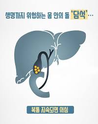  간호학과 담석증GBstone 원인증상위험요인 문헌고찰: 담석병태생리 간호케이스