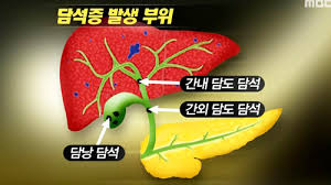  간호학 담석증GBstone 증상진단검사 문헌고찰: 담석증징후특징 간호케이스