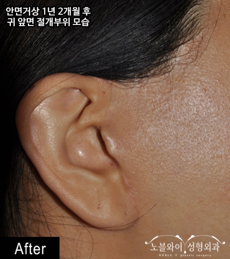  안면거상술흉터 걱정된다구요?