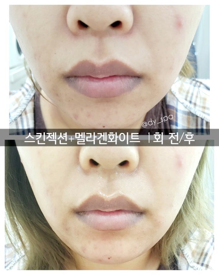  코로나 피부극복프로그램, 서귀포 피부관리 전문샵  도민 최대 40% 할인쿠폰 정보!