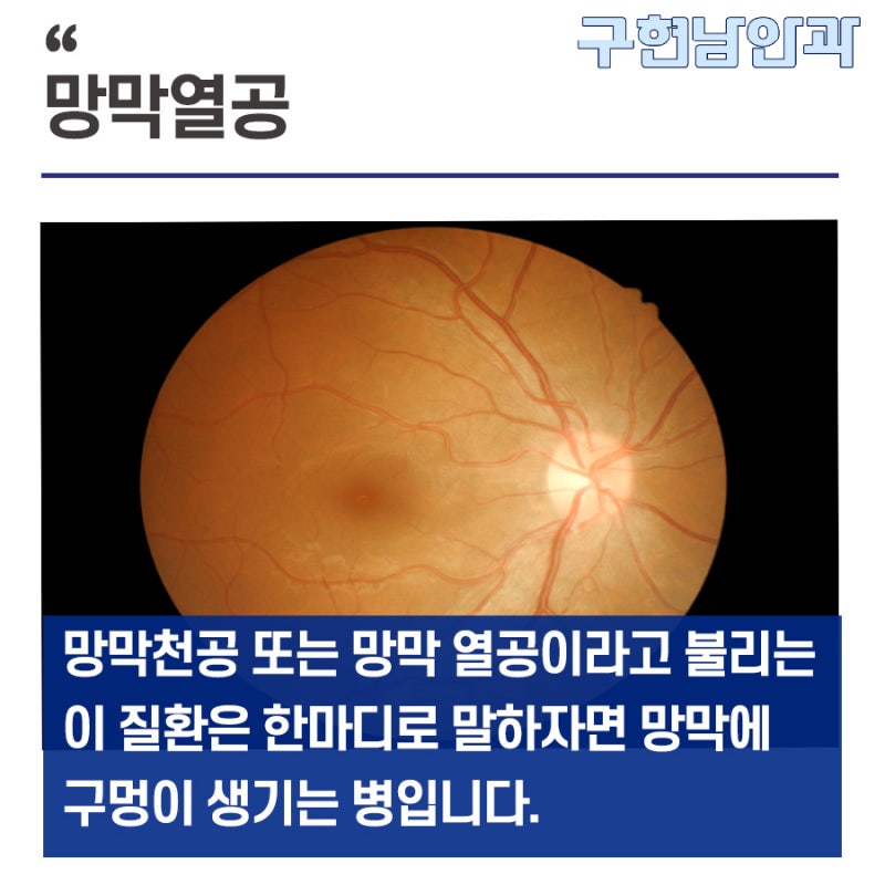 [인제안과] 망막 열공 어떤 증상이 있나요? 3