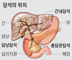  간호학과 담석증GBstone예방법 수술간호: 문헌고찰간호중재케이스