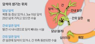  간호학 담석증GBstone약물종류 수술치료방법: 담석쇄석술충격파 간호중재
