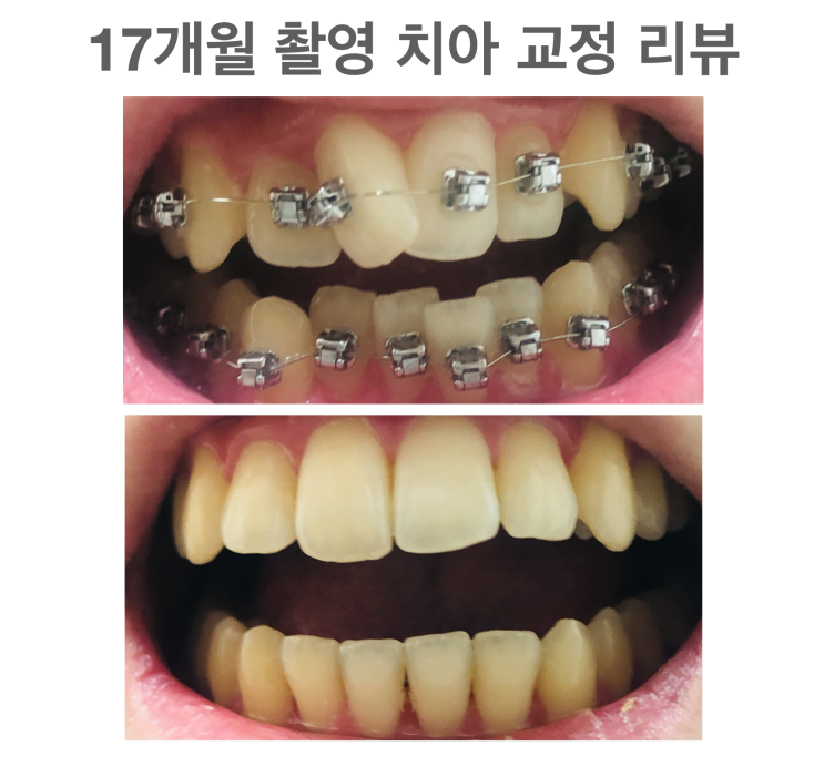 17개월만에 끝난 치아 교정 후기 (치아 변화 영상)