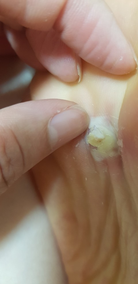  발바닥티눈치료 발바닥티눈제거 발바닥티눈밴드와 티눈약으로 발바닥티눈치료하기