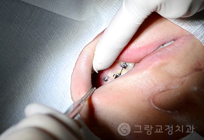 교정 스크류 빠짐 이렇게 해야해요 : 네이버 블로그 교정 스크류 빠짐 이렇게 해야해요 : 네이버 블로그