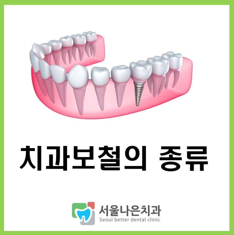 보철치료의 종류는 무엇이 있을까. 크라운, 브릿지, 틀니