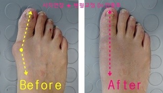  무지외반증의 완벽한 교정