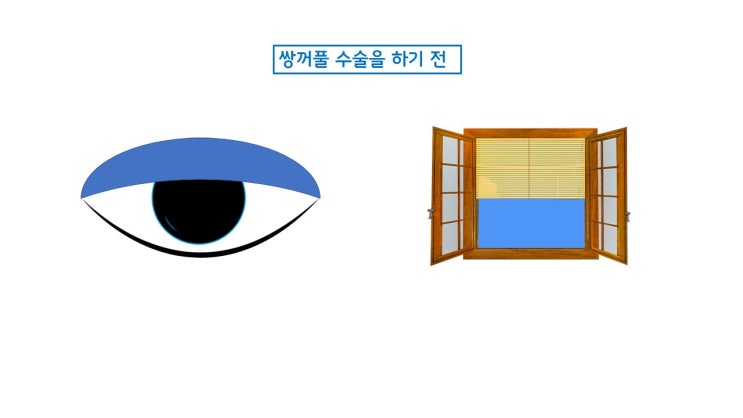  멘붕! 쌍수 눈크기 커질 줄 알았는데....