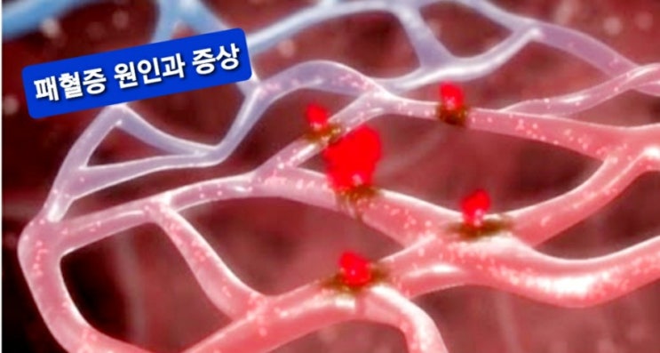 패혈증 원인, 패혈증 증상 알아보기