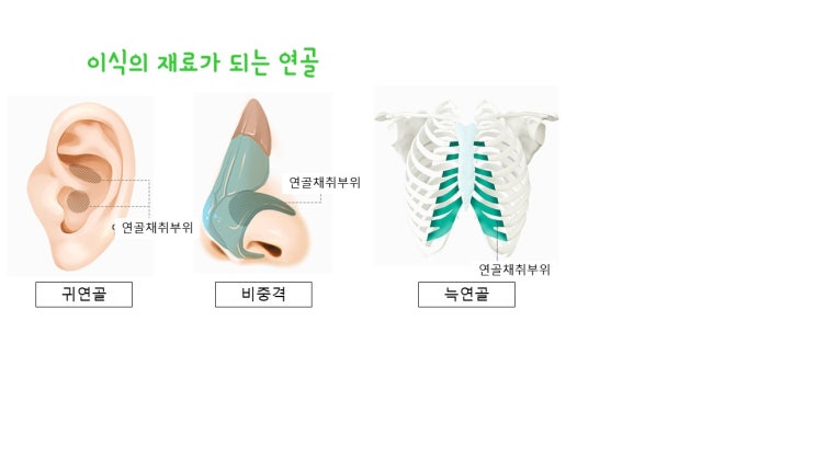  코성형 관련 도대체 모르겠는 연골의 모든 것