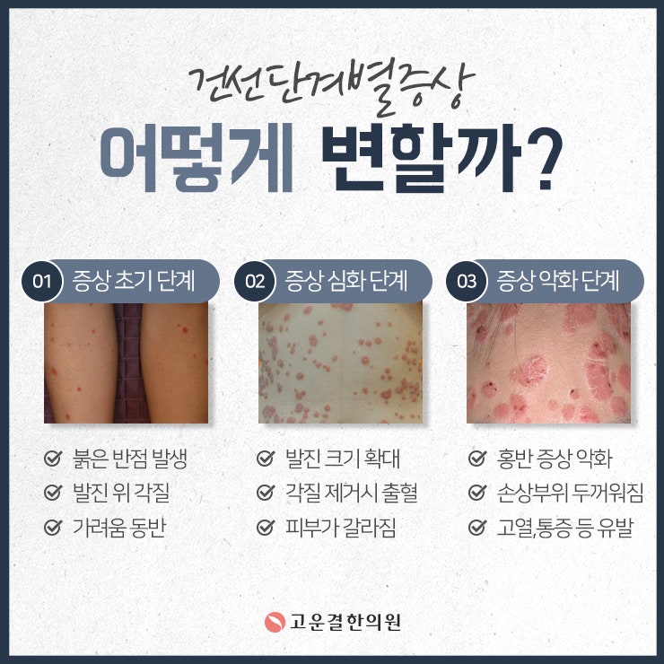 건선한의원에서는 피부의 하얀 각질을 치료합니다 3