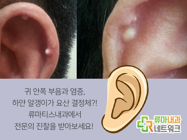귀 안쪽 부음 염증 생각지도 못한 Oo 때문에? : 네이버 블로그
