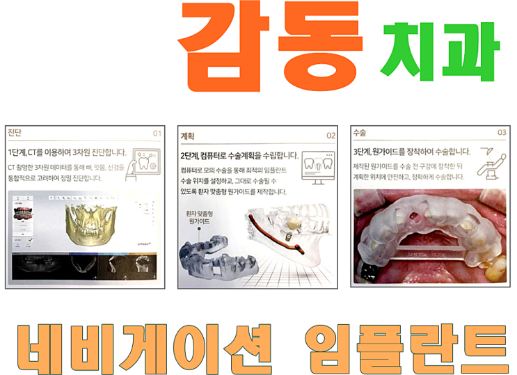  당감동 임플란트 잘하는 치과 감동치과