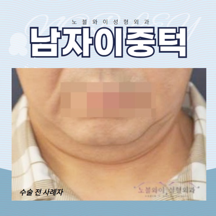  남자이중턱 꼭 수술 해야하나요?