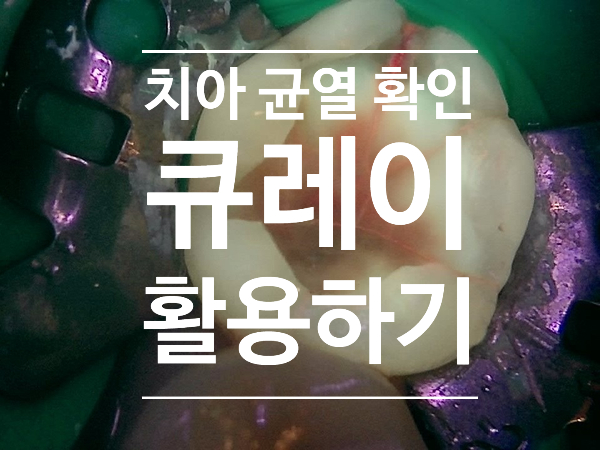 금이 간 치아 확인하기(균열된 치아) / 크랙 치아(crack tooth) 확인하기, 큐레이 (Q-ray) 활용하기 금이 간 치아 확인하기(균열된 치아) / 크랙 치아(crack tooth) 확인하기, 큐레이 (Q-ray) 활용하기