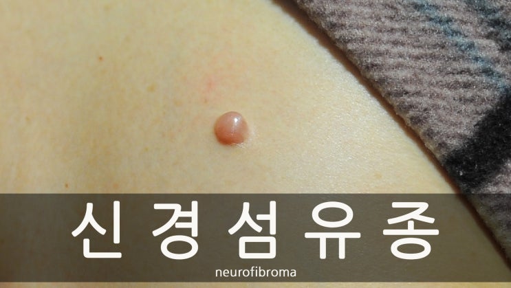  신경섬유종 '가슴 위쪽에 발생한 섬유종 피판술 실시'