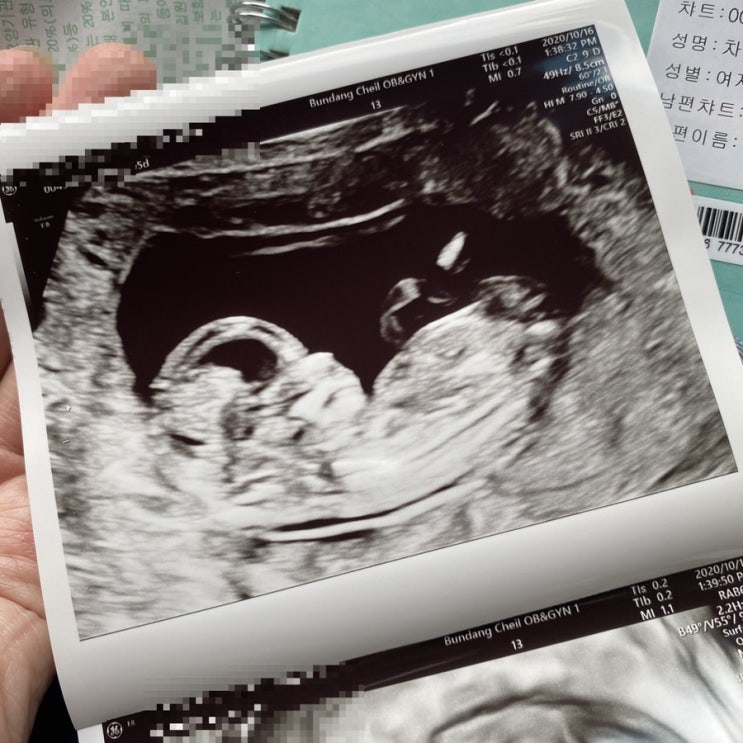 임신 12주 초음파 , 1차 기형아검사