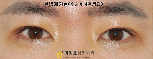 마침표성형외과_#남자눈매교정후기#무쌍눈매교정후기 : 네이버 블로그 마침표성형외과_#남자눈매교정후기#무쌍눈매교정후기 : 네이버 블로그