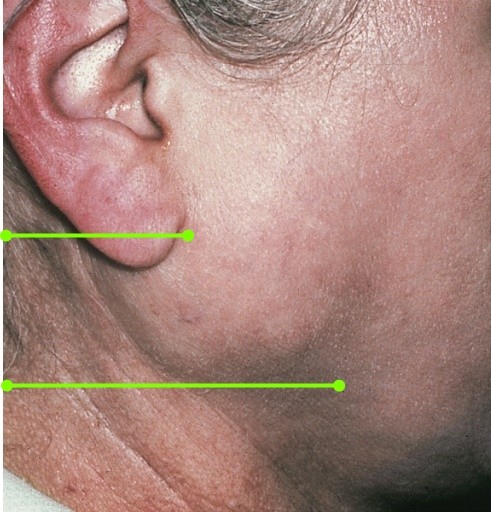 귀밑샘 턱밑샘 뿔룩! 귀밑 귀아래통증.턱밑 턱아래통증 없애는법 : 네이버 블로그