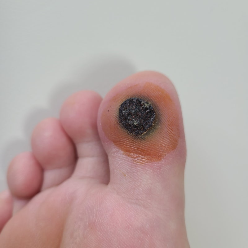 족저 사마귀치료 말끔히 나은