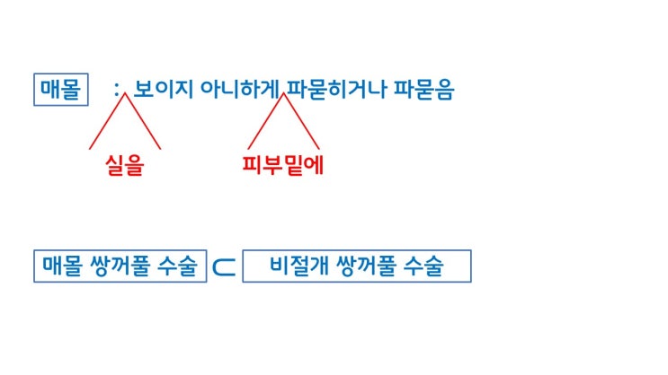  매몰, 자연유착 차이 제대로 알려 드림