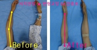  팔 골절 후유증 수술