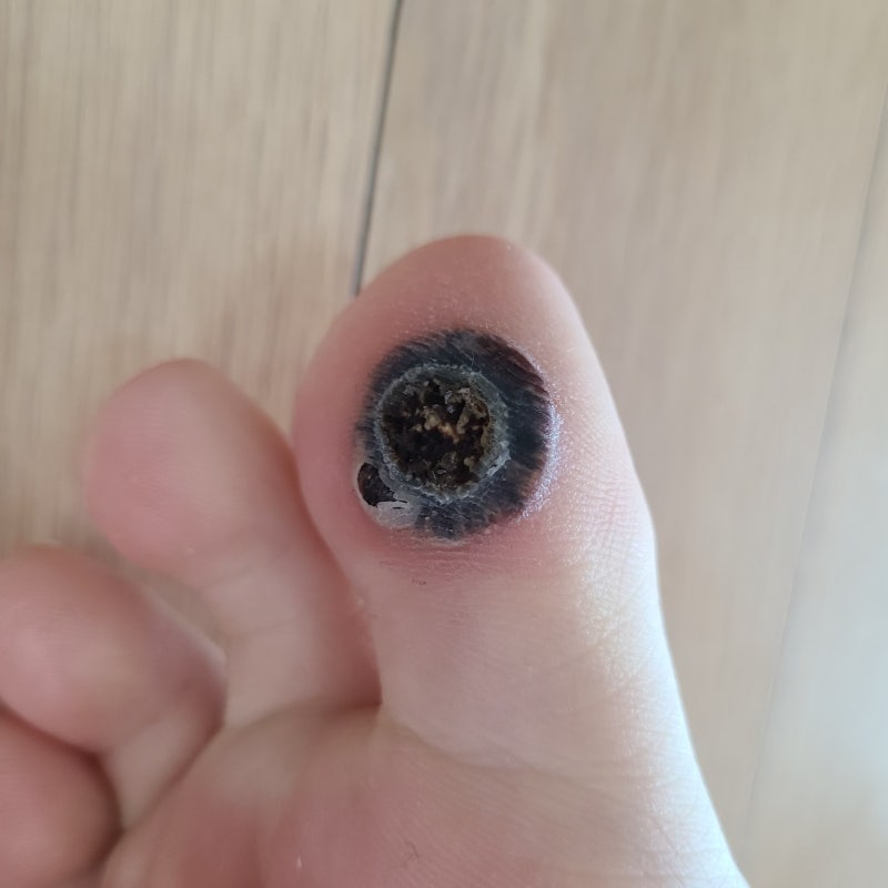 족저 사마귀치료 말끔히 나은 7