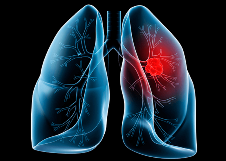 폐암 초기증상 9가지 무엇인지