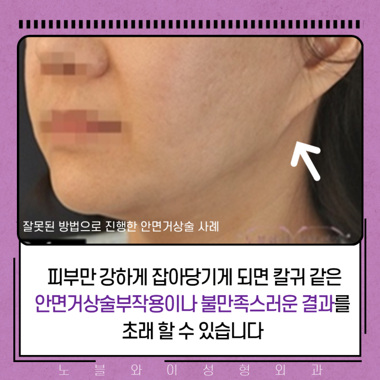  안면거상술부작용 꼭 생기나요?
