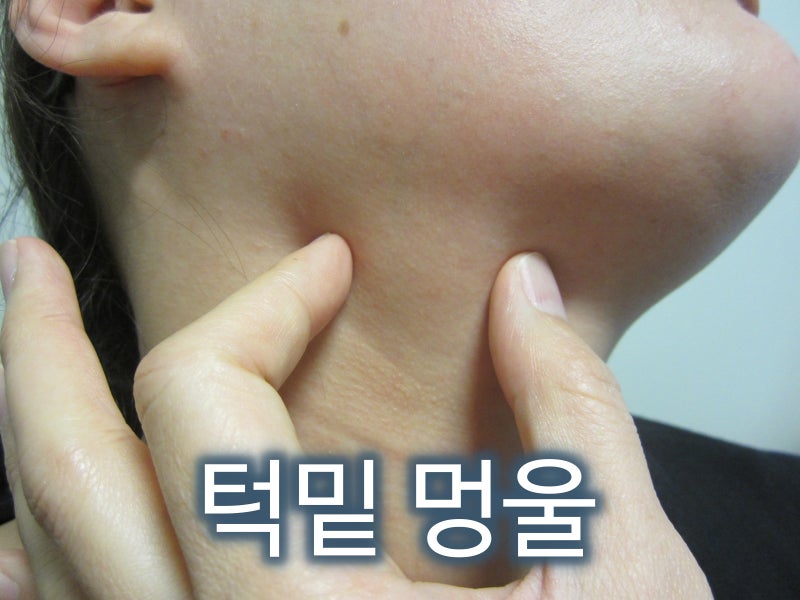 턱 밑에 목 아래, 침샘 림프절 멍울 몽우리가 만져질 때, 환자가 체크해 볼 수 있는, 그리고 ....