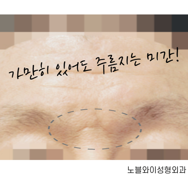  미간주름수술 받으니 인상이 ?