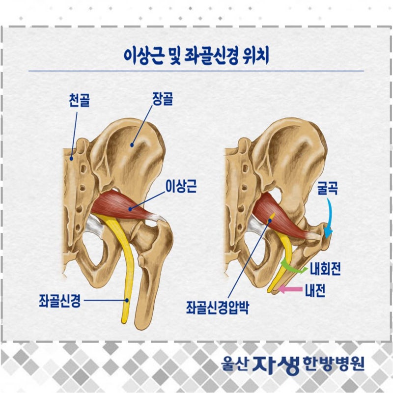 [울산관절병원] 의자에서도 양반다리? 이상근증후군 주의! : 네이버 블로그