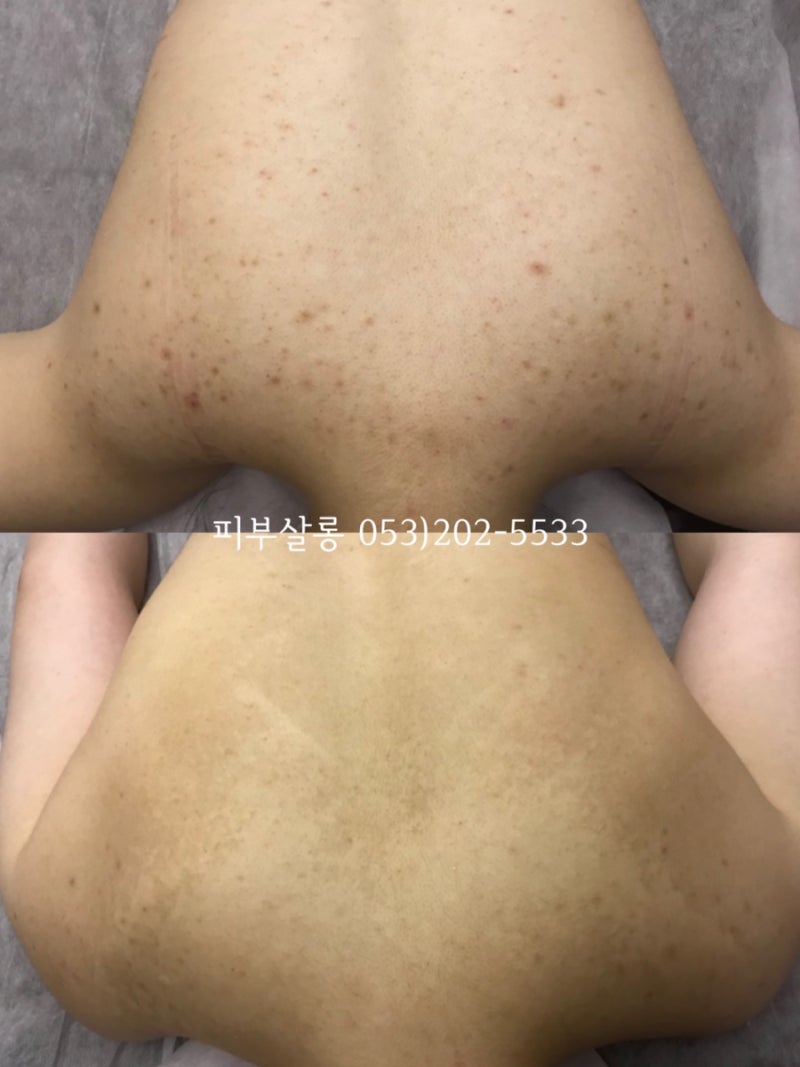 대구피부관리실)달서구 알라딘필링팔여드름자국재생케어리뷰/죽전동피부관리실 15