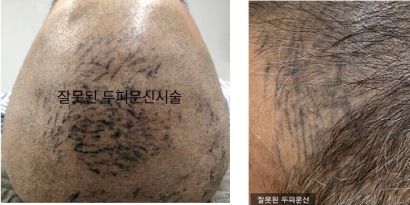 SMP 두피문신 부작용 유형별 솔루션 총정리! 1