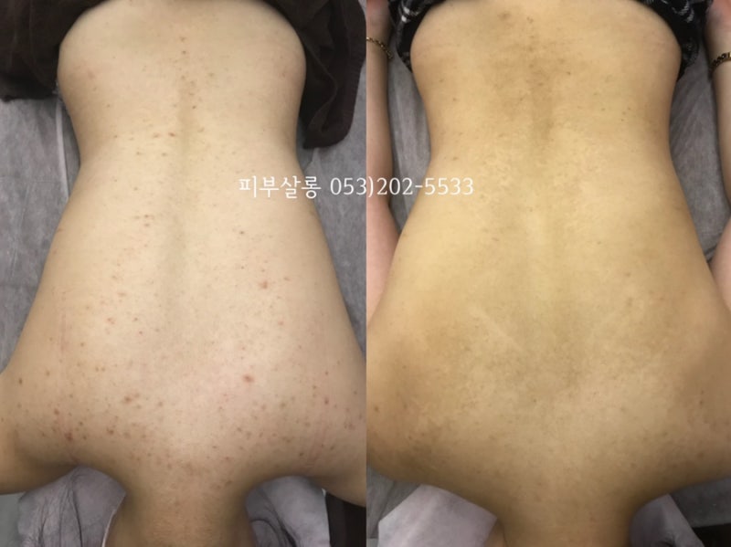 대구피부관리실)달서구 알라딘필링팔여드름자국재생케어리뷰/죽전동피부관리실 9
