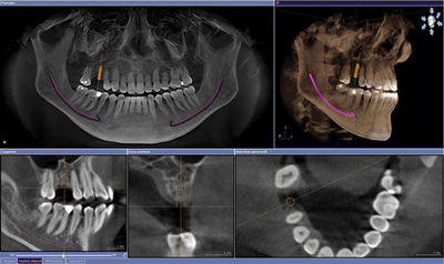 양악수술&gt; 양악수술에 있어 콘빔CT는?? (Cone Beam CT) -&gt; X-ray보다 정확??
