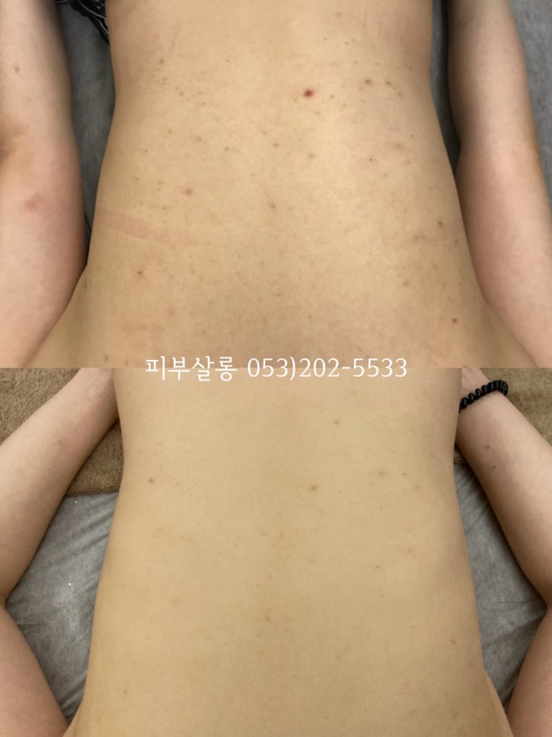 대구피부관리실)달서구 알라딘필링팔여드름자국재생케어리뷰/죽전동피부관리실 5