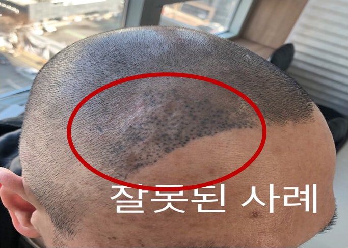 SMP 두피문신 부작용 유형별 솔루션 총정리! 4