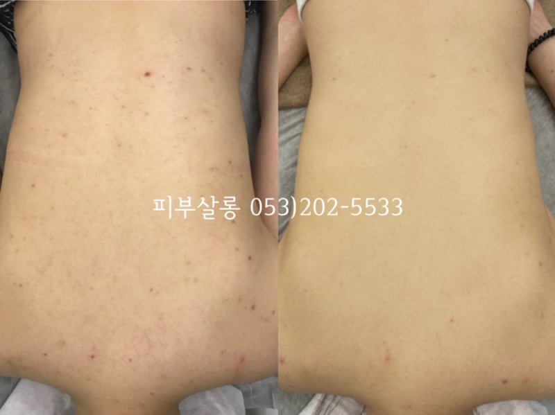대구피부관리실)달서구 알라딘필링팔여드름자국재생케어리뷰/죽전동피부관리실 6
