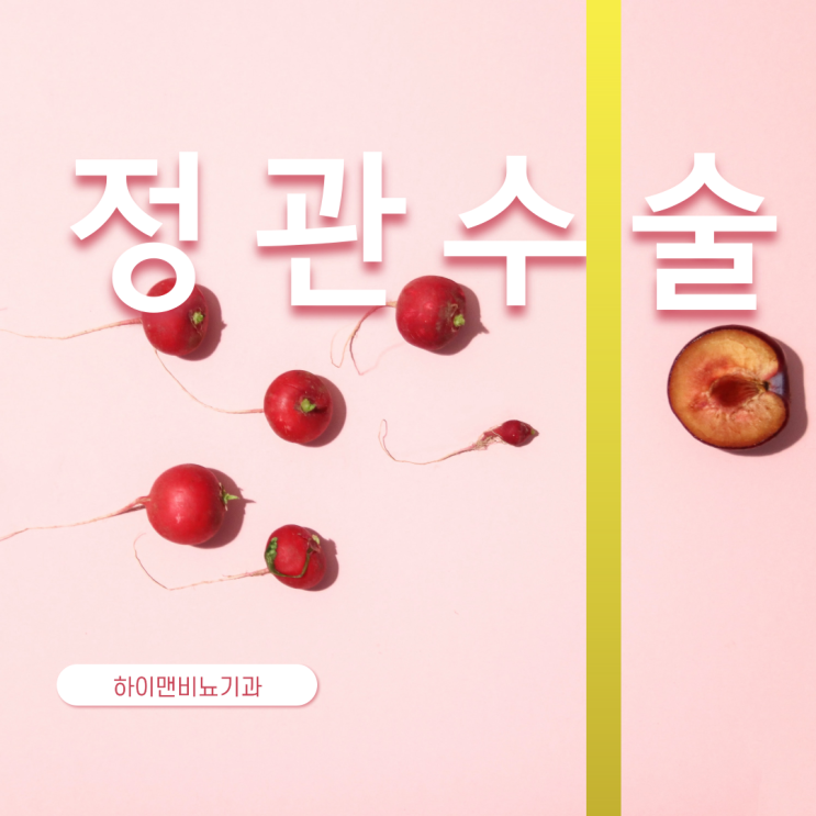  남자 묶는 수술 정관 결찰술 방법