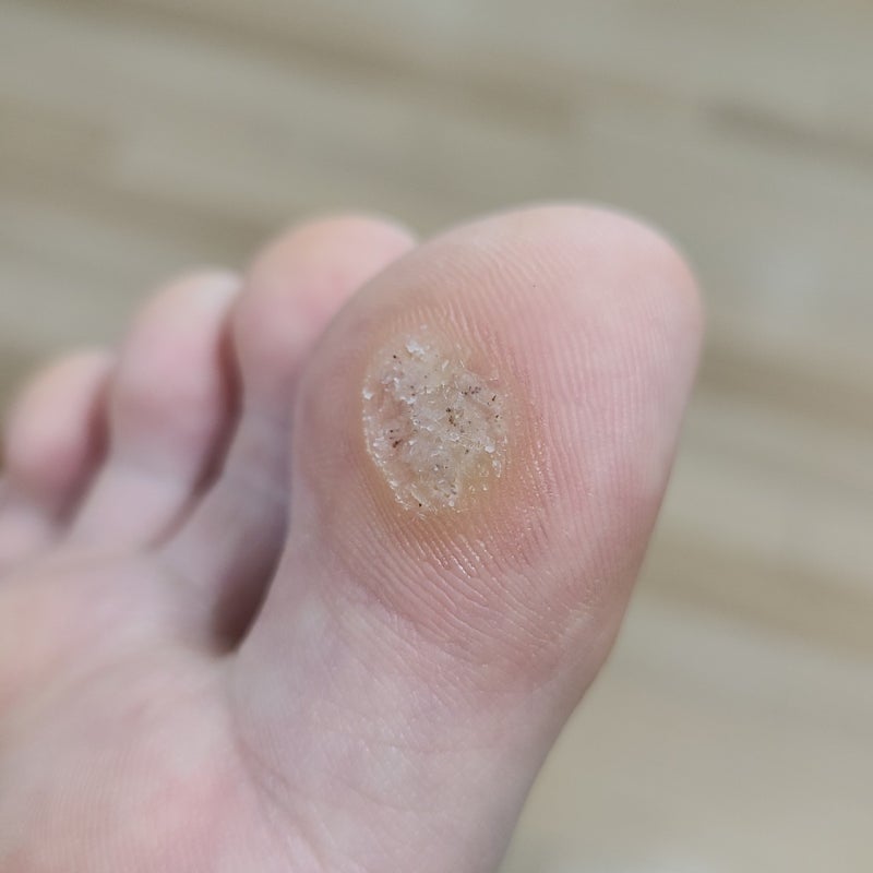족저 사마귀치료 말끔히 나은 8
