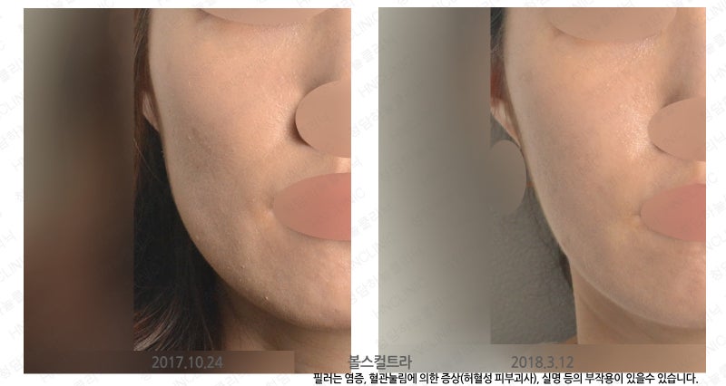 볼스컬트라 4개월 후 모습과 4
