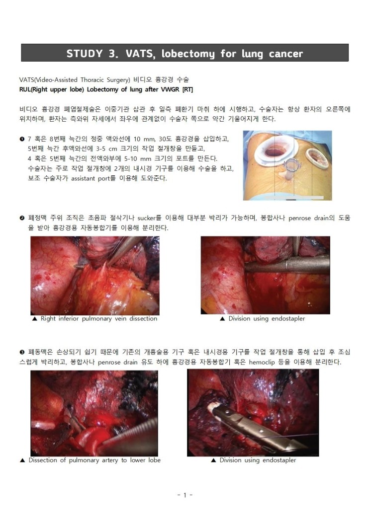 STUDY 3. VATS lobectomy for lung cancer