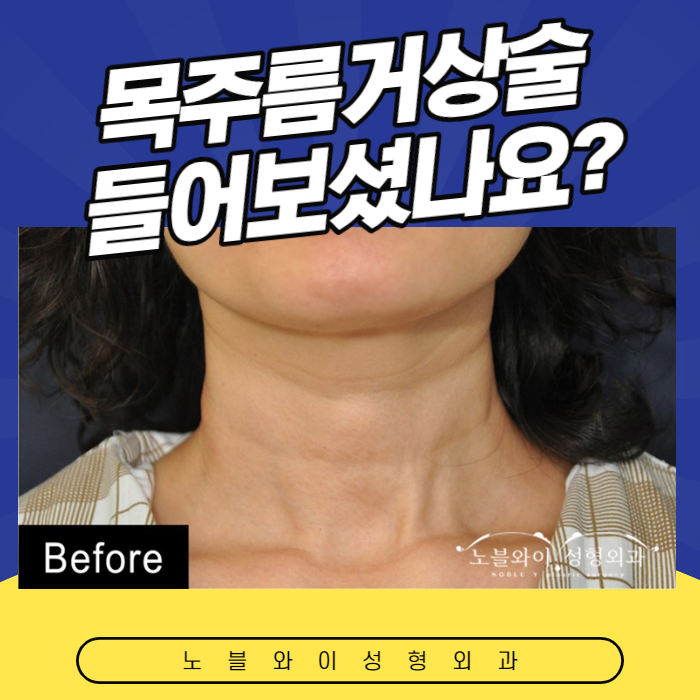  목주름거상술 아무데서나 하면 안돼요