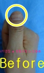  손톱 물어뜯는 버릇으로 생긴 변형
