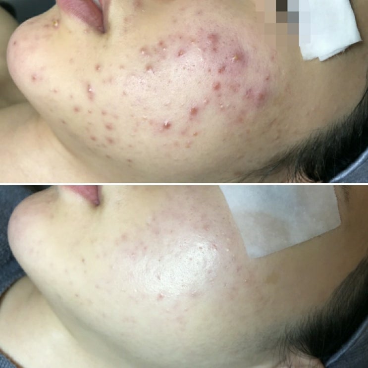  여드름색소침착, 여드름흉터 만드는 화농성여드름관리는 구로디지털단지피부관리실 압출잘하는곳 하이스킨
